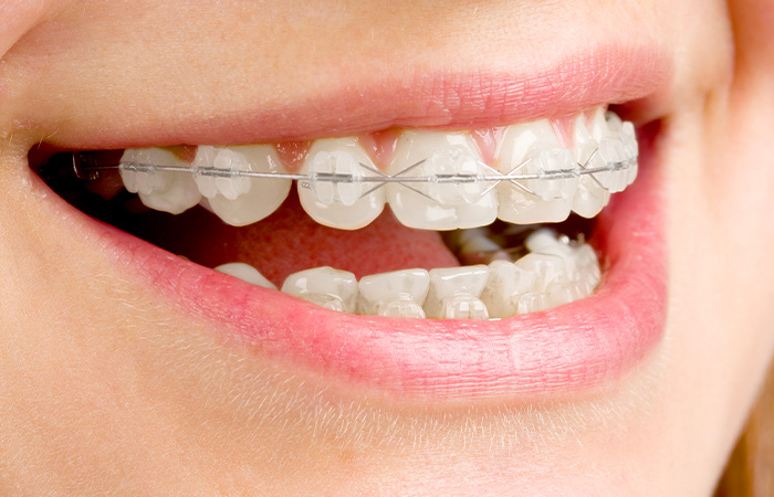 ブラケット矯正