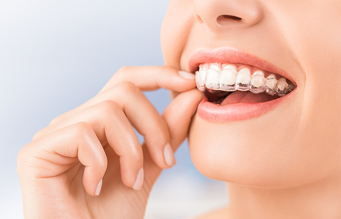 マウスピース型矯正装置