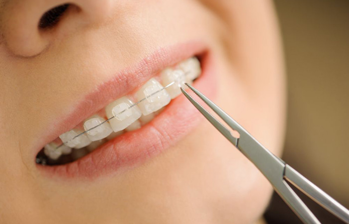 矯正装置の装着