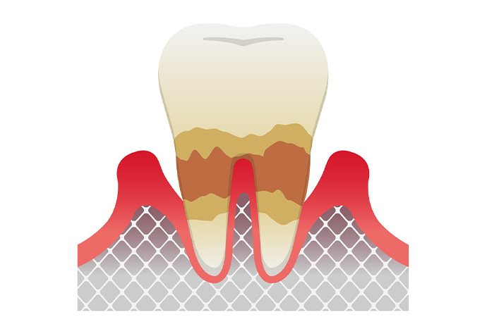 中度の歯周炎