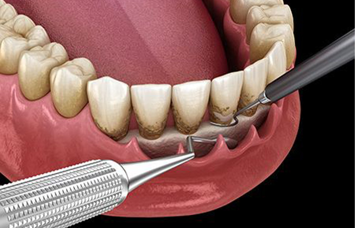 進行した歯周病の治療